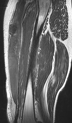Figure 5 for case rectus femoris indirect head proximal myotendinous junction tear with hematoma( RID2698 )